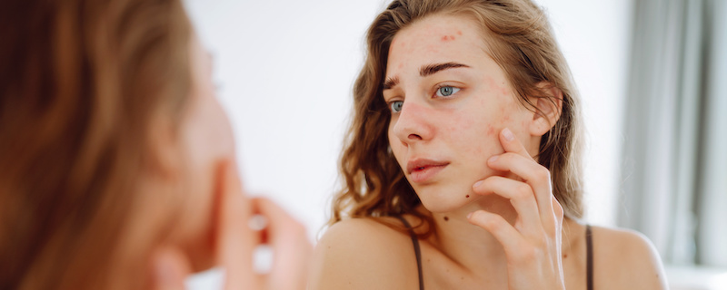 Acne Treatment Near Me