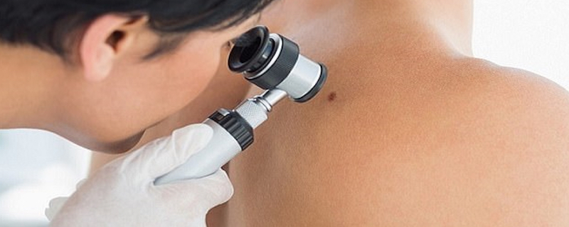 Annual Skin Checks by Dr. Gurgen
