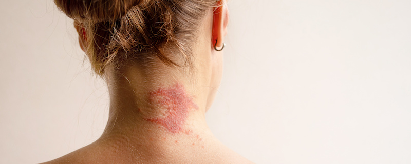 Dermatitis Treatment in Leesburg Florida