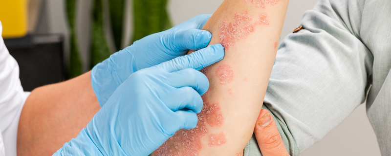 eczema treatment in leesburg florida