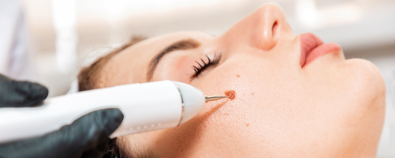 Professional salon procedures. Surgeon using a laser device for removing mole. Removal of birthmark from female face. Close up. Concept of laser cosmelotogy and electrocoagulation mole removal treatment in Leesburg Florida